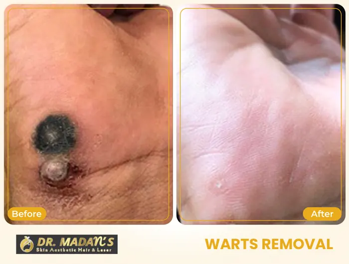 Warts removal before and after result 2 at Dr Madan Aesthetics